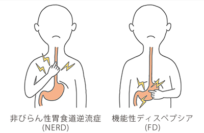 （図）非びらん性胃食道逆流症（NERD）と機能性ディスペプシア（FD）の不快感が生じる場所の違い