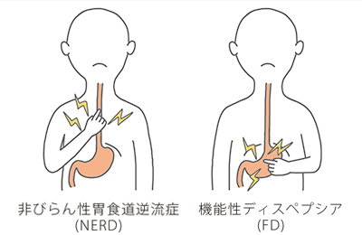 胸焼け 対処