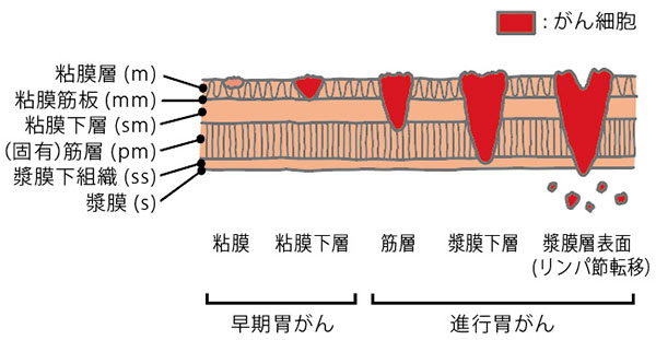 スキルス 性 胃がん と は