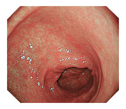 胃の内視鏡写真